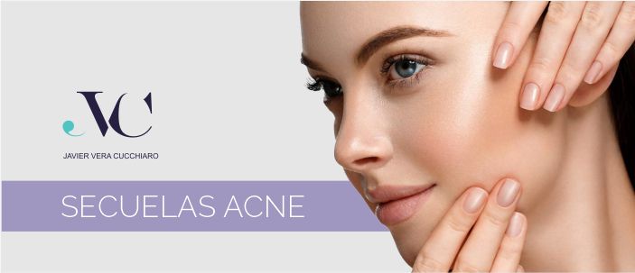 imagen acne